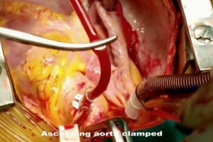 Video: Heart Surgery filmed on Nokia Lumia 1020, Lilavati Hospital, Mumbai India